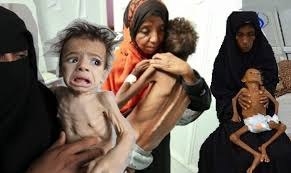 الصحة العالمية: 46 % من الأطفال دون سن الخامسة في اليمن يعانون من "التقزم" و 16 % يعانون من "الهزال"